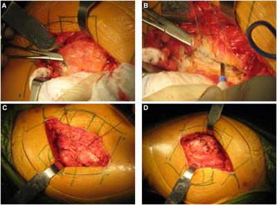 Abductor muscle function after anterolateral approach in patients with unilateral end-stage hip osteoarthritis undergoing total hip arthroplasty: A prospective study